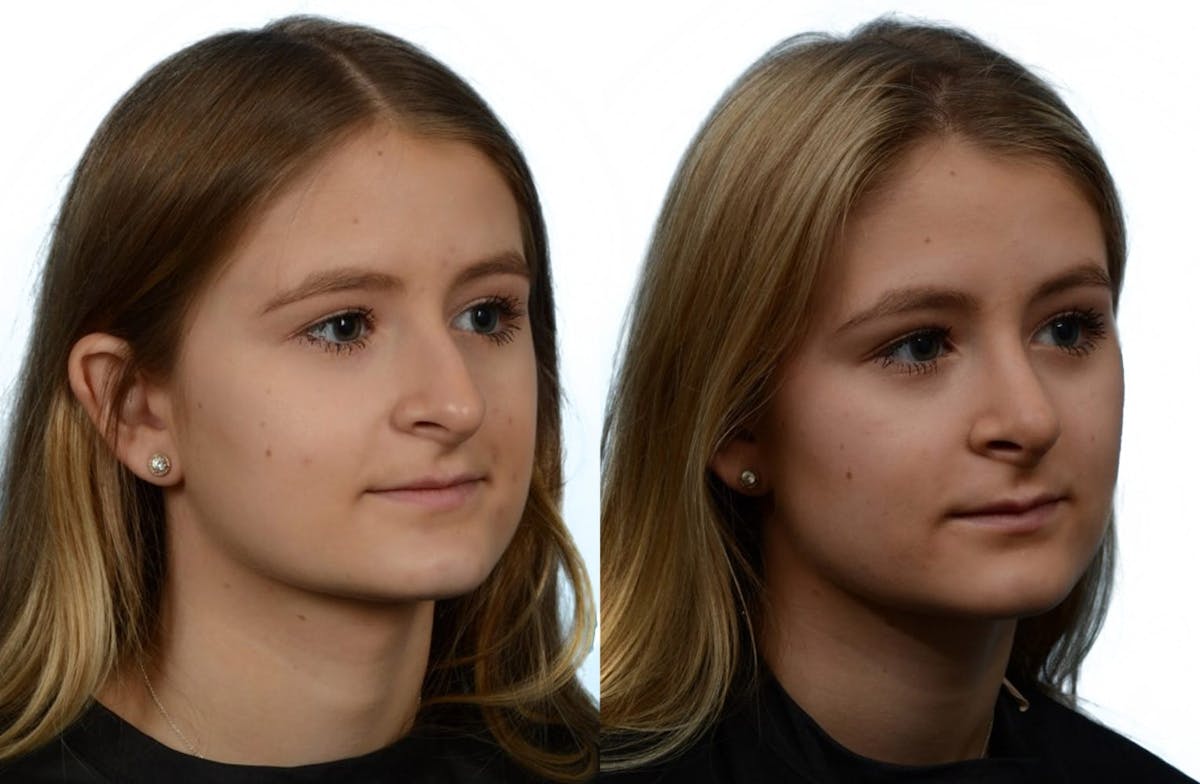 Rhinoplasty Before & After Gallery - Patient 213435 - Image 2