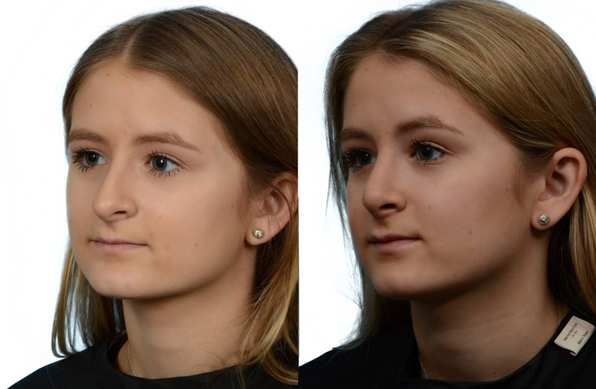 Rhinoplasty Before & After Gallery - Patient 213435 - Image 3