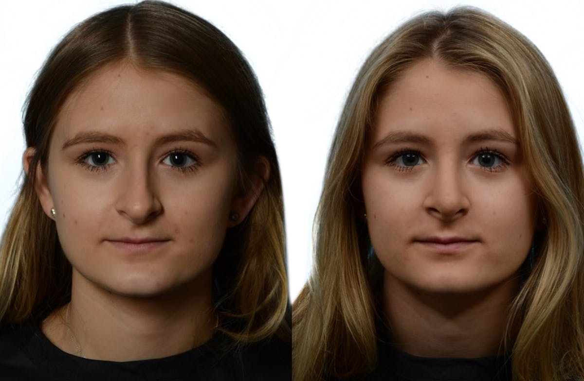 Rhinoplasty Before & After Gallery - Patient 213435 - Image 4