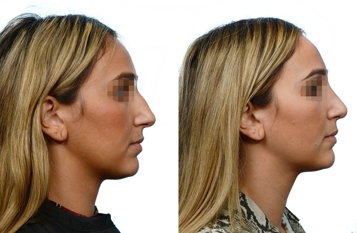 Rhinoplasty Before & After Gallery - Patient 414787 - Image 1