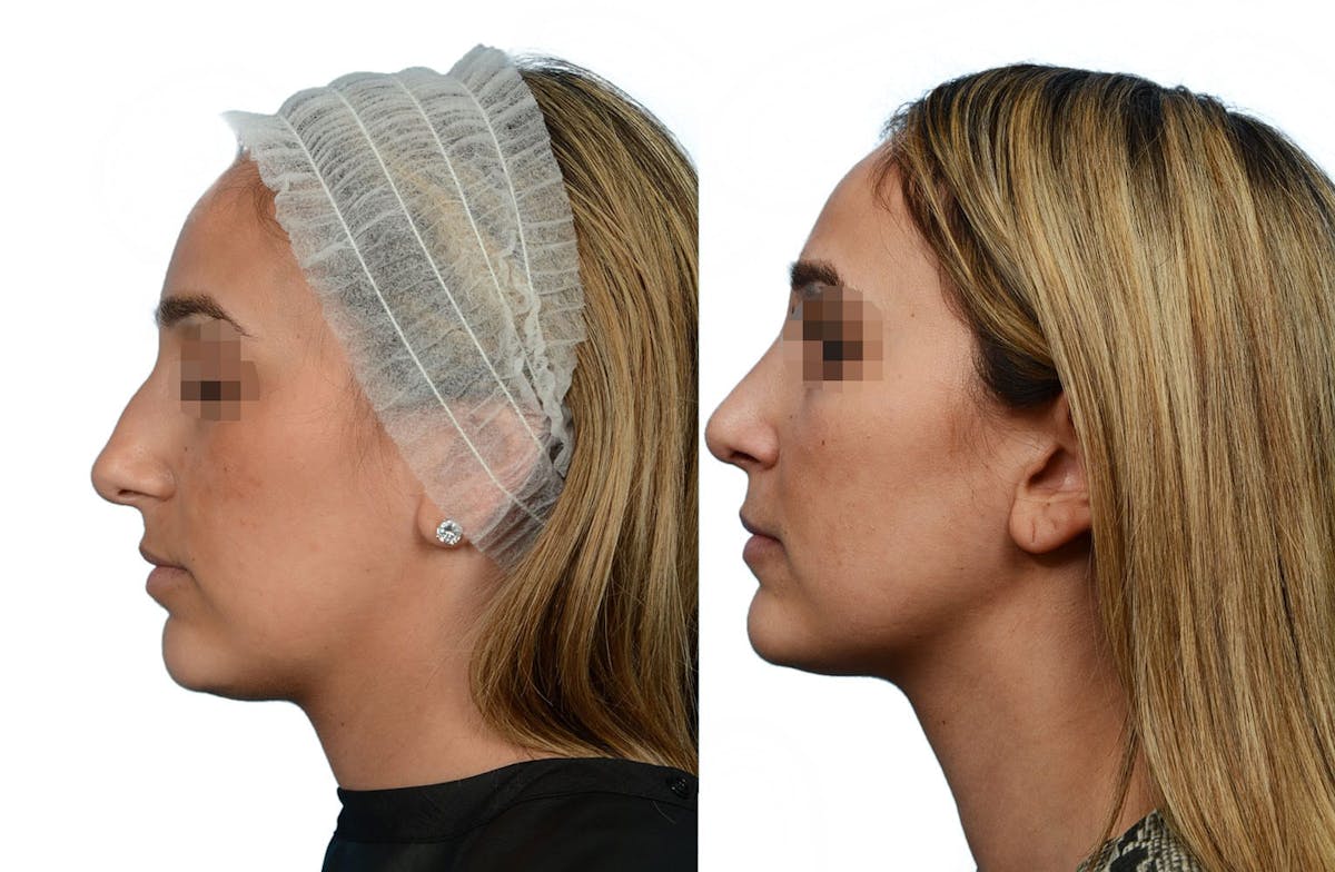Rhinoplasty Before & After Gallery - Patient 414787 - Image 2
