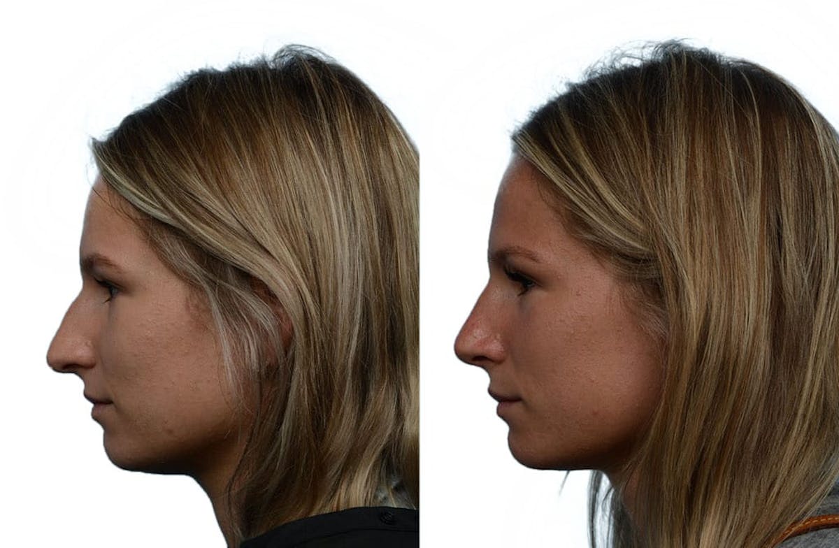 Rhinoplasty Before & After Gallery - Patient 443799 - Image 1