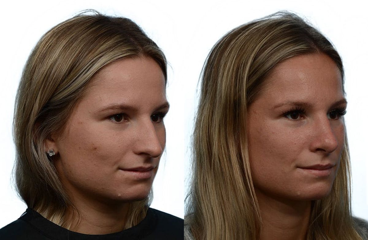 Rhinoplasty Before & After Gallery - Patient 443799 - Image 2