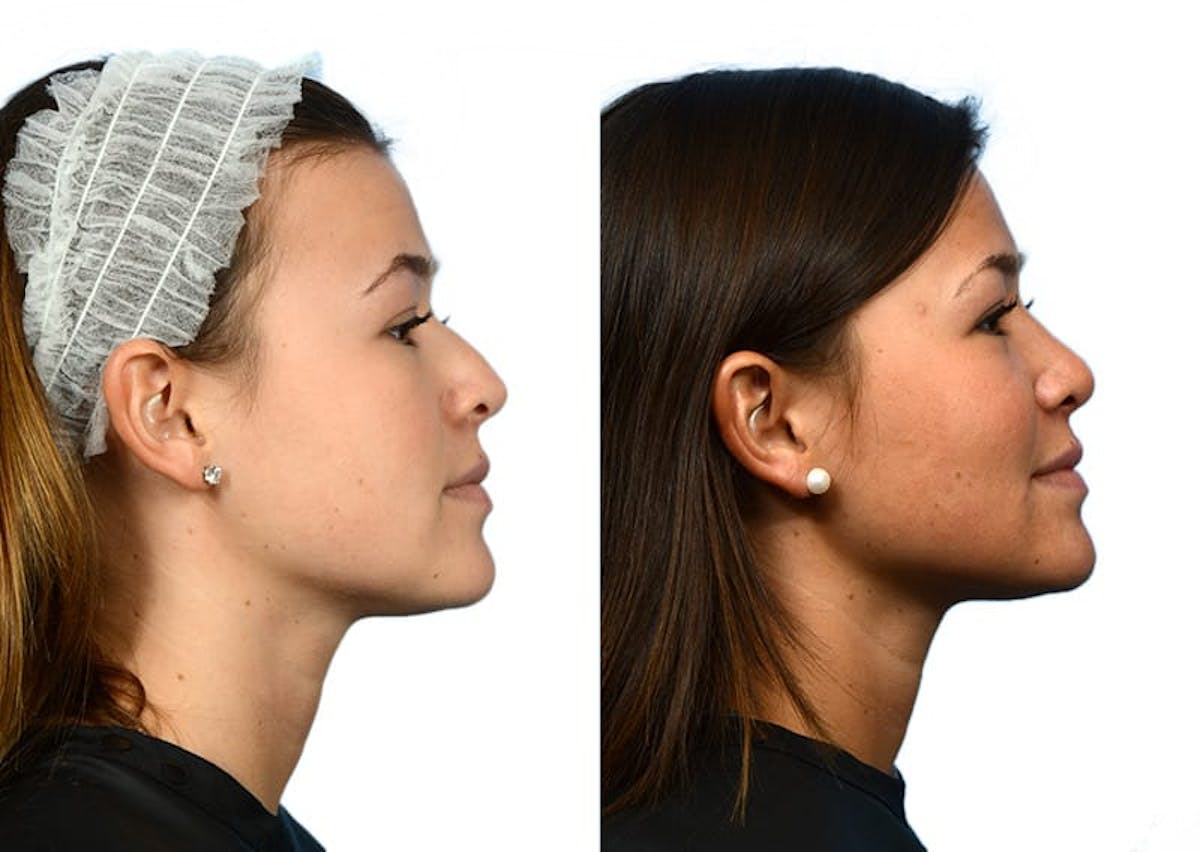 Rhinoplasty Before & After Gallery - Patient 674253 - Image 1