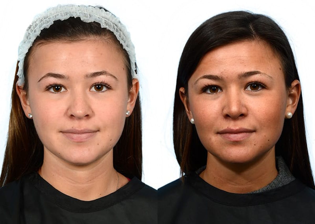 Rhinoplasty Before & After Gallery - Patient 674253 - Image 2