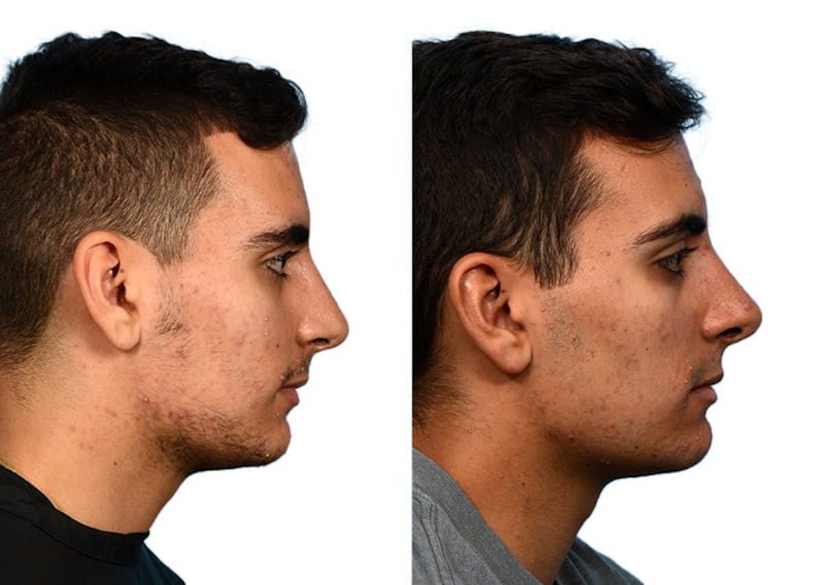 Rhinoplasty Before & After Gallery - Patient 166950 - Image 1