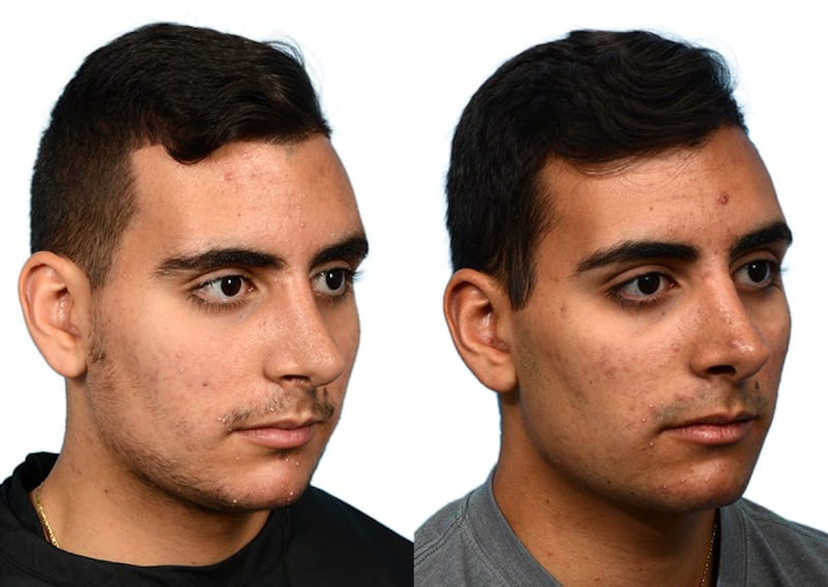 Rhinoplasty Before & After Gallery - Patient 166950 - Image 2