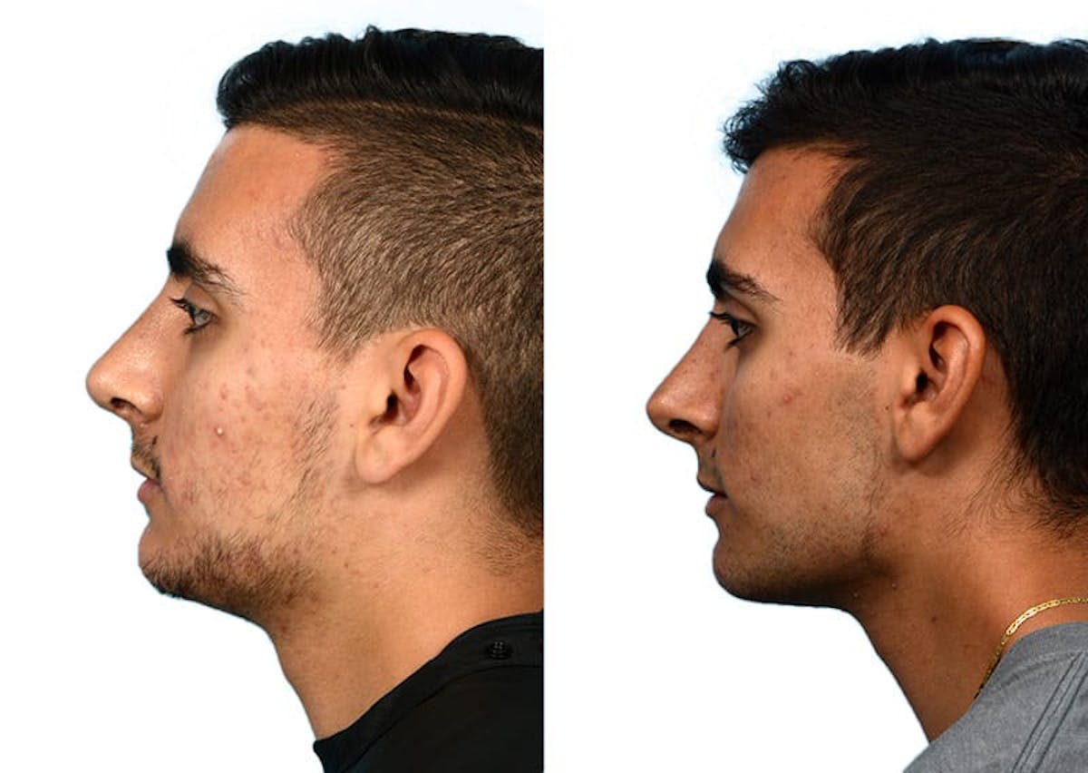 Rhinoplasty Before & After Gallery - Patient 166950 - Image 3