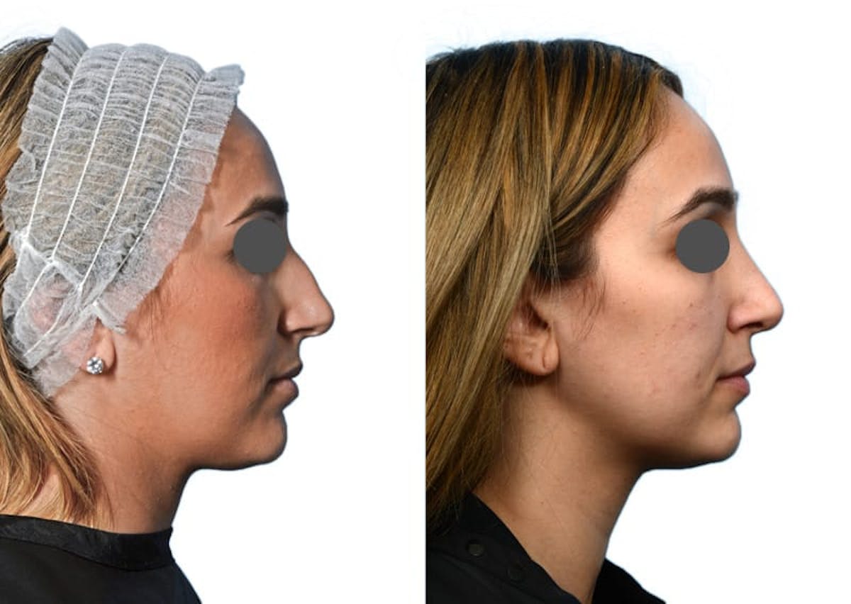 Rhinoplasty Before & After Gallery - Patient 317415 - Image 1