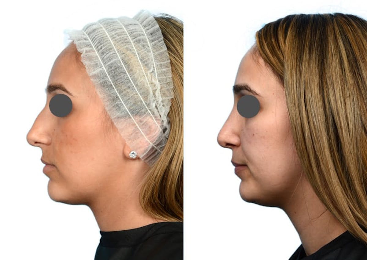 Rhinoplasty Before & After Gallery - Patient 317415 - Image 2