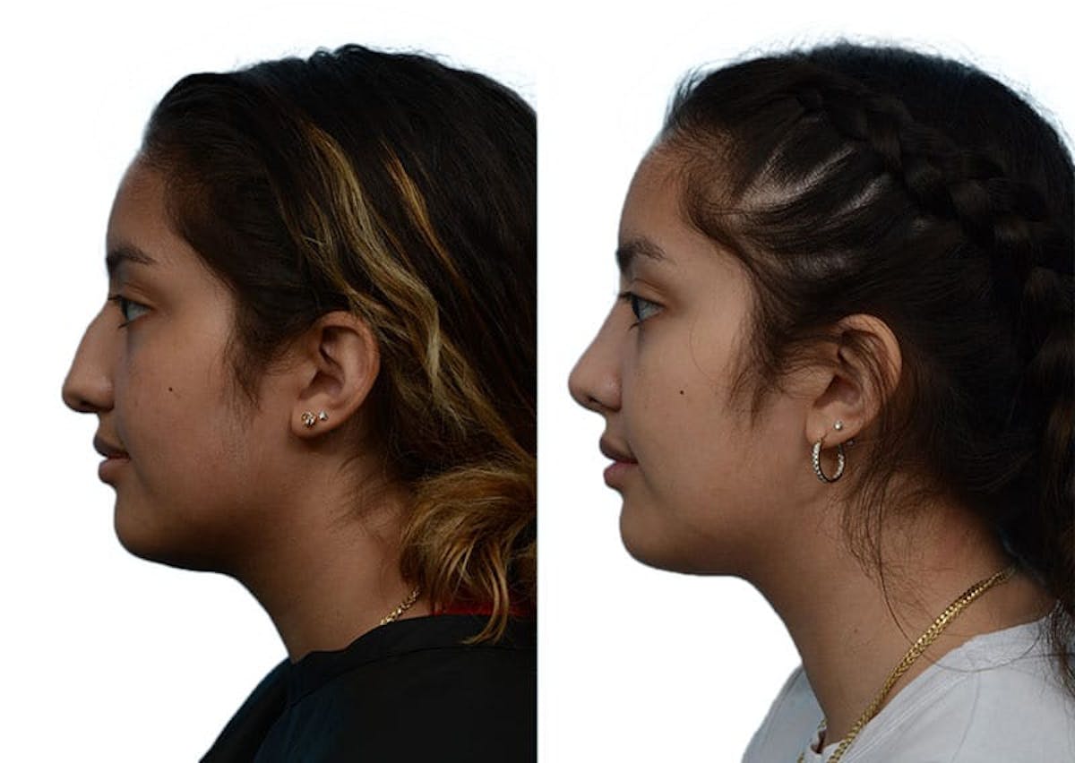 Rhinoplasty Before & After Gallery - Patient 190567 - Image 2