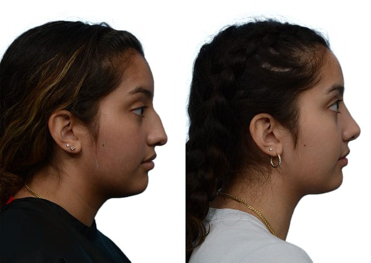 Rhinoplasty Before & After Gallery - Patient 190567 - Image 1