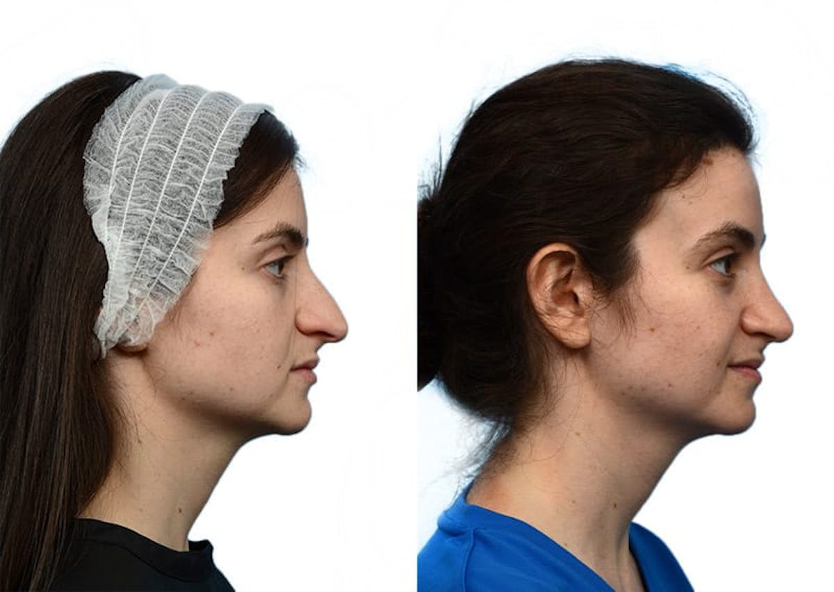 Rhinoplasty Before & After Gallery - Patient 179682 - Image 1