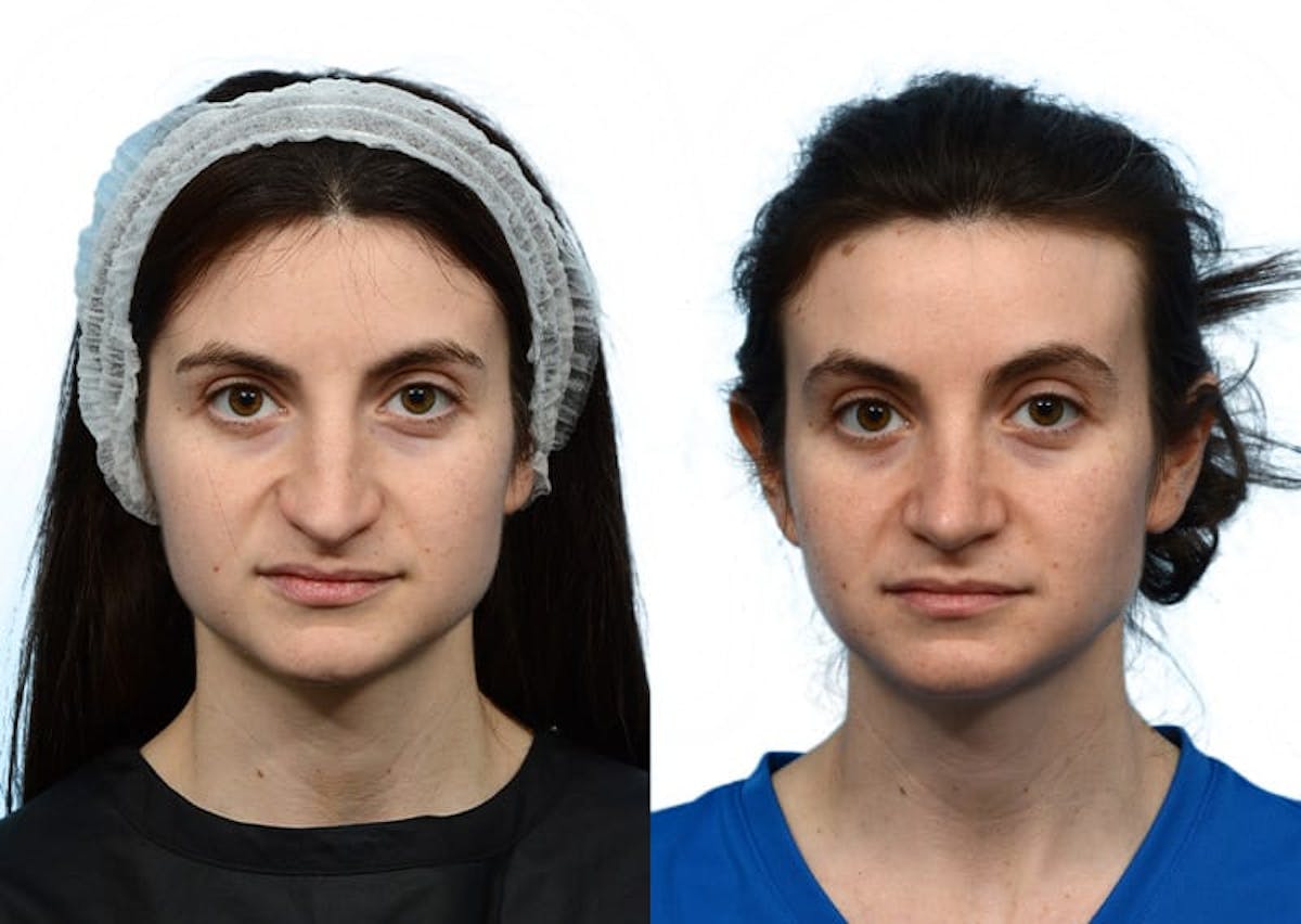Rhinoplasty Before & After Gallery - Patient 179682 - Image 2