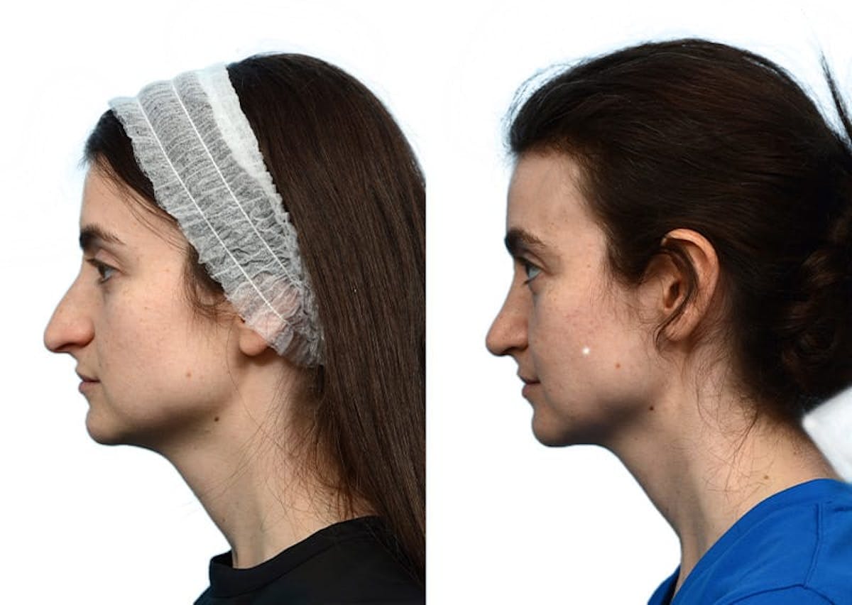 Rhinoplasty Before & After Gallery - Patient 179682 - Image 3