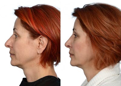Rhinoplasty Before & After Gallery - Patient 267465 - Image 1