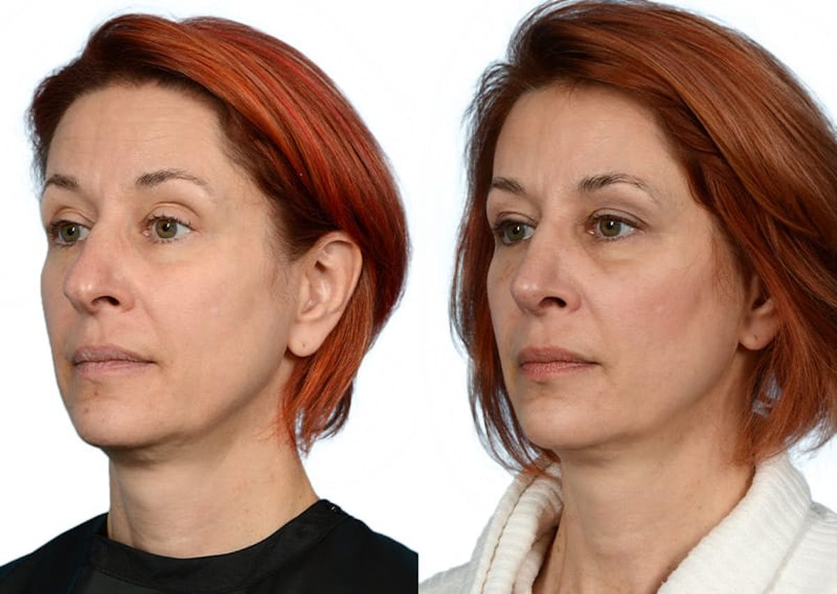 Rhinoplasty Before & After Gallery - Patient 267465 - Image 2