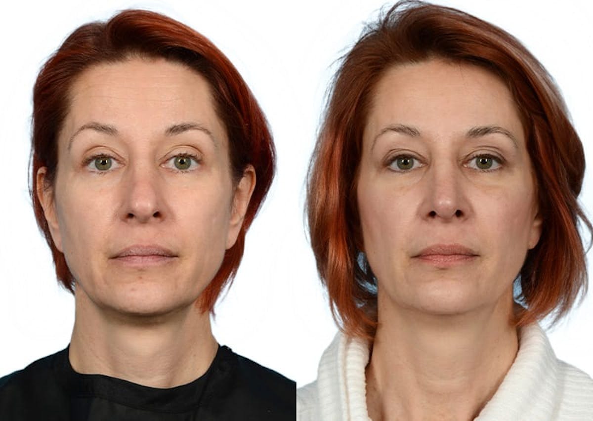 Rhinoplasty Before & After Gallery - Patient 267465 - Image 3
