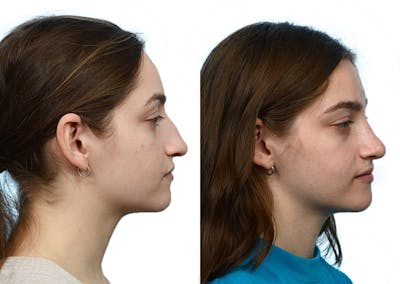Rhinoplasty Before & After Gallery - Patient 160383 - Image 1