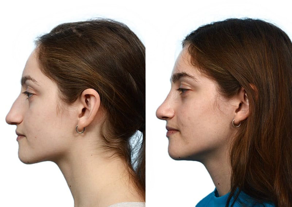Rhinoplasty Before & After Gallery - Patient 160383 - Image 2