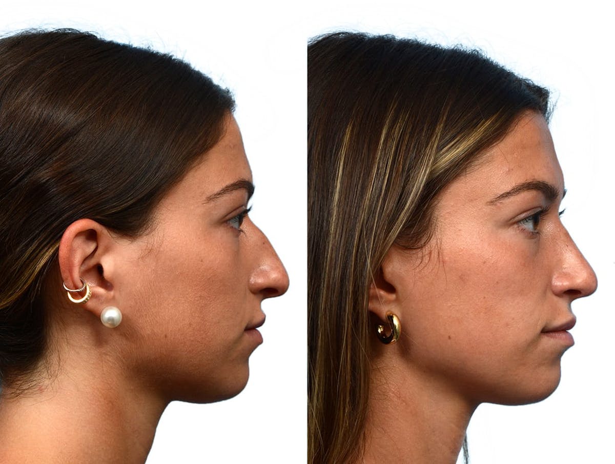 Rhinoplasty Before & After Gallery - Patient 268259 - Image 1
