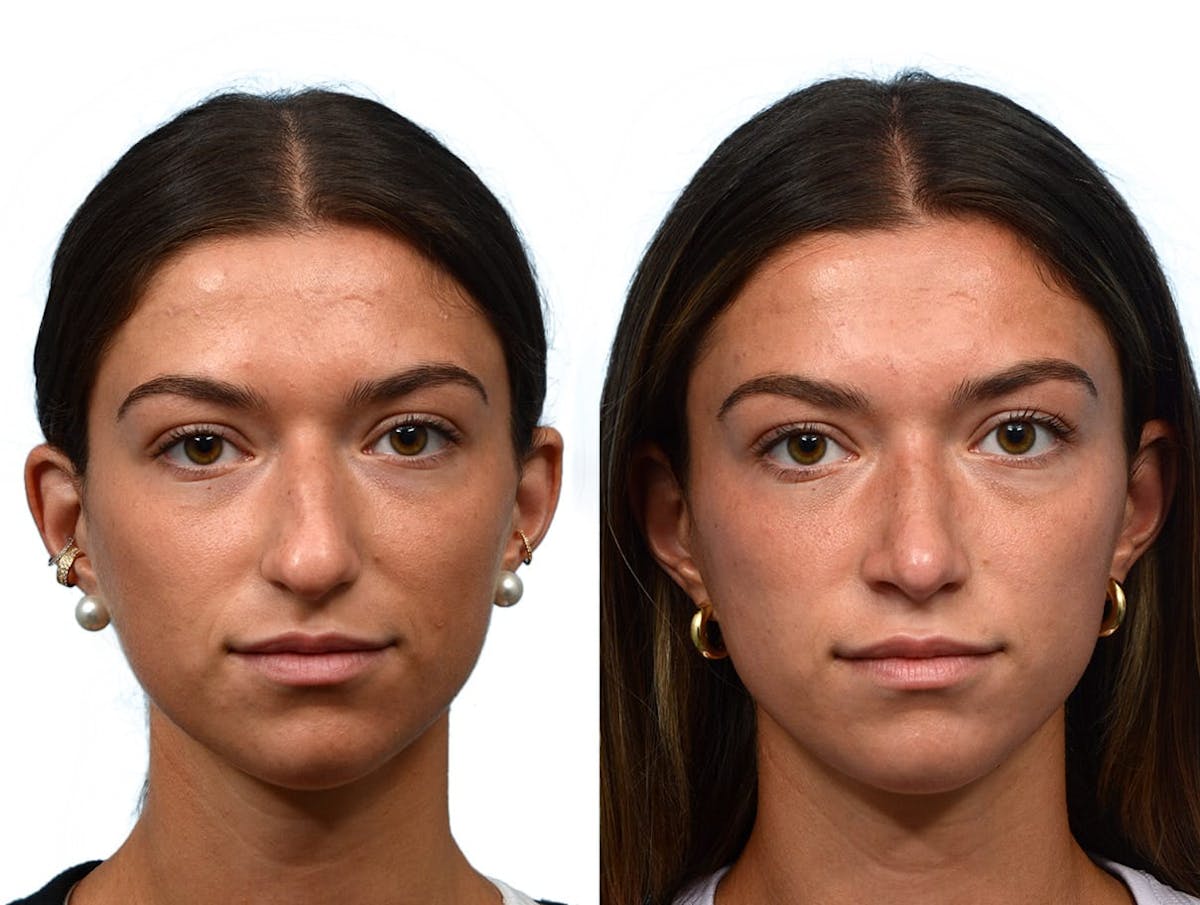 Rhinoplasty Before & After Gallery - Patient 268259 - Image 2