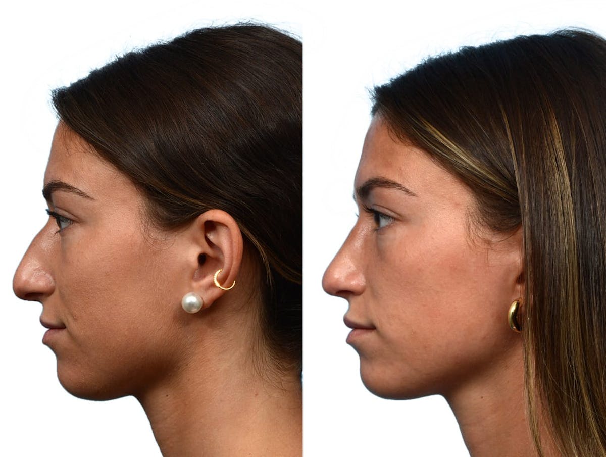 Rhinoplasty Before & After Gallery - Patient 268259 - Image 3