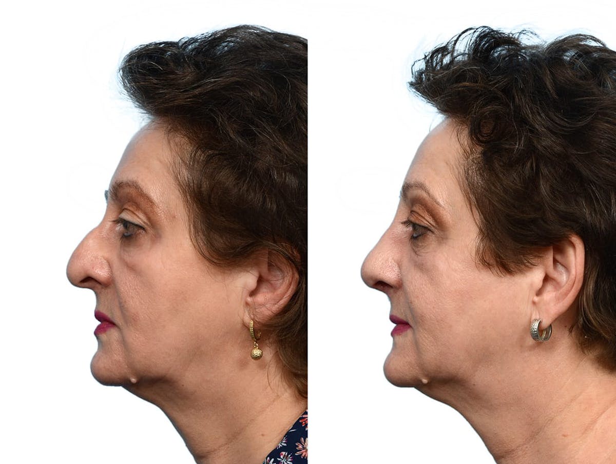 Rhinoplasty Before & After Gallery - Patient 781347 - Image 2