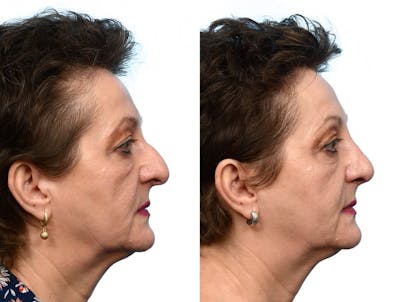 Rhinoplasty Before & After Gallery - Patient 781347 - Image 1