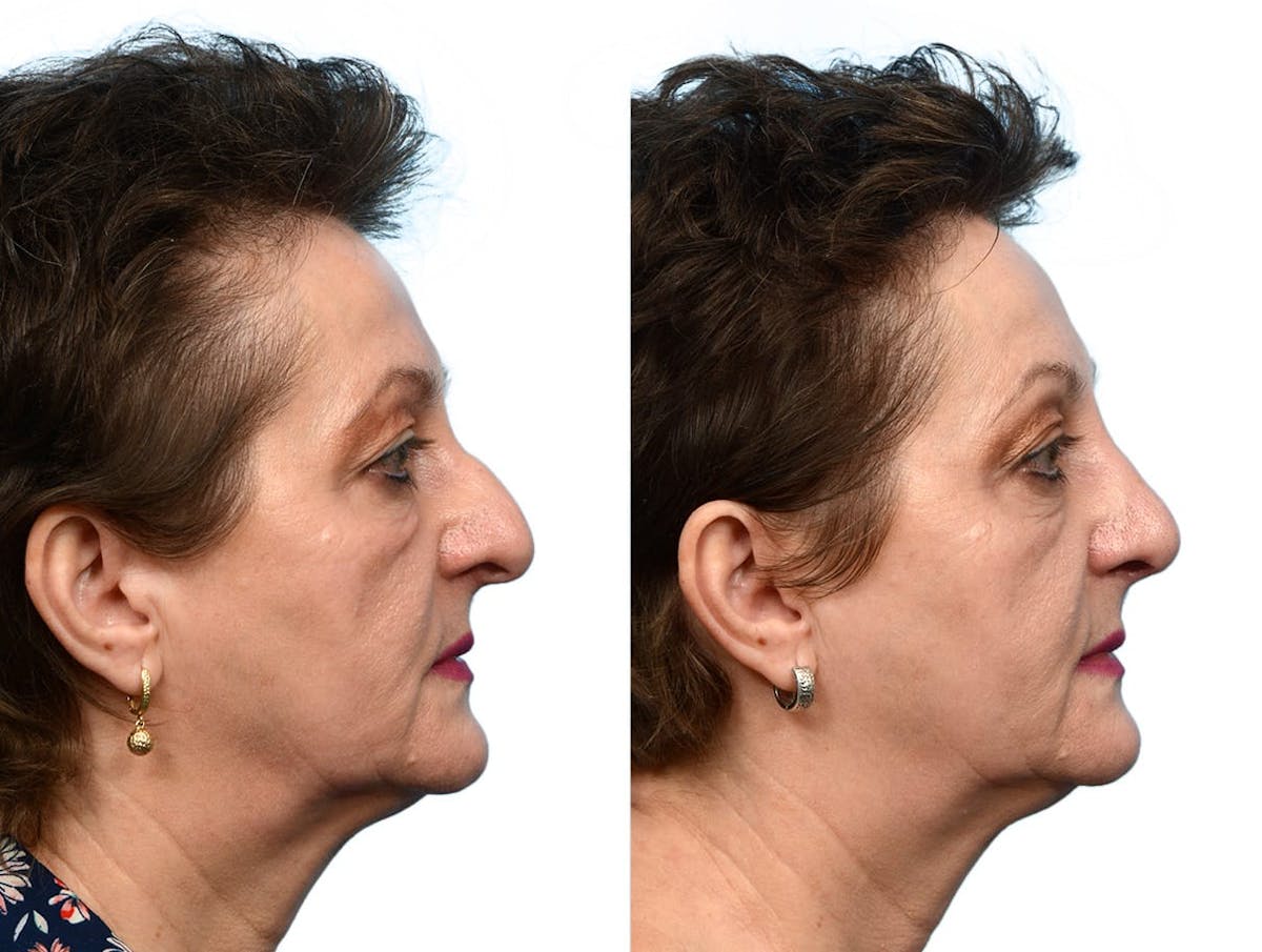 Rhinoplasty Before & After Gallery - Patient 781347 - Image 1