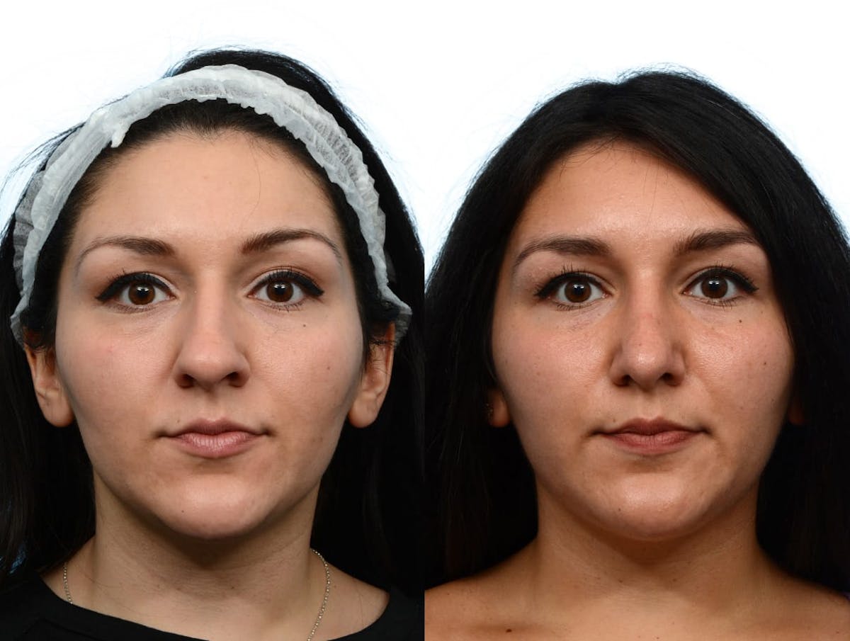 Rhinoplasty Before & After Gallery - Patient 231216 - Image 1