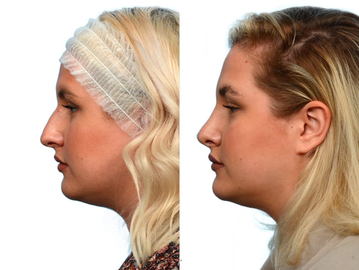 Rhinoplasty Before & After Gallery - Patient 180325 - Image 2