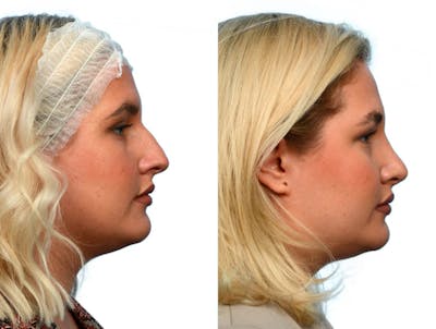 Rhinoplasty Before & After Gallery - Patient 180325 - Image 1