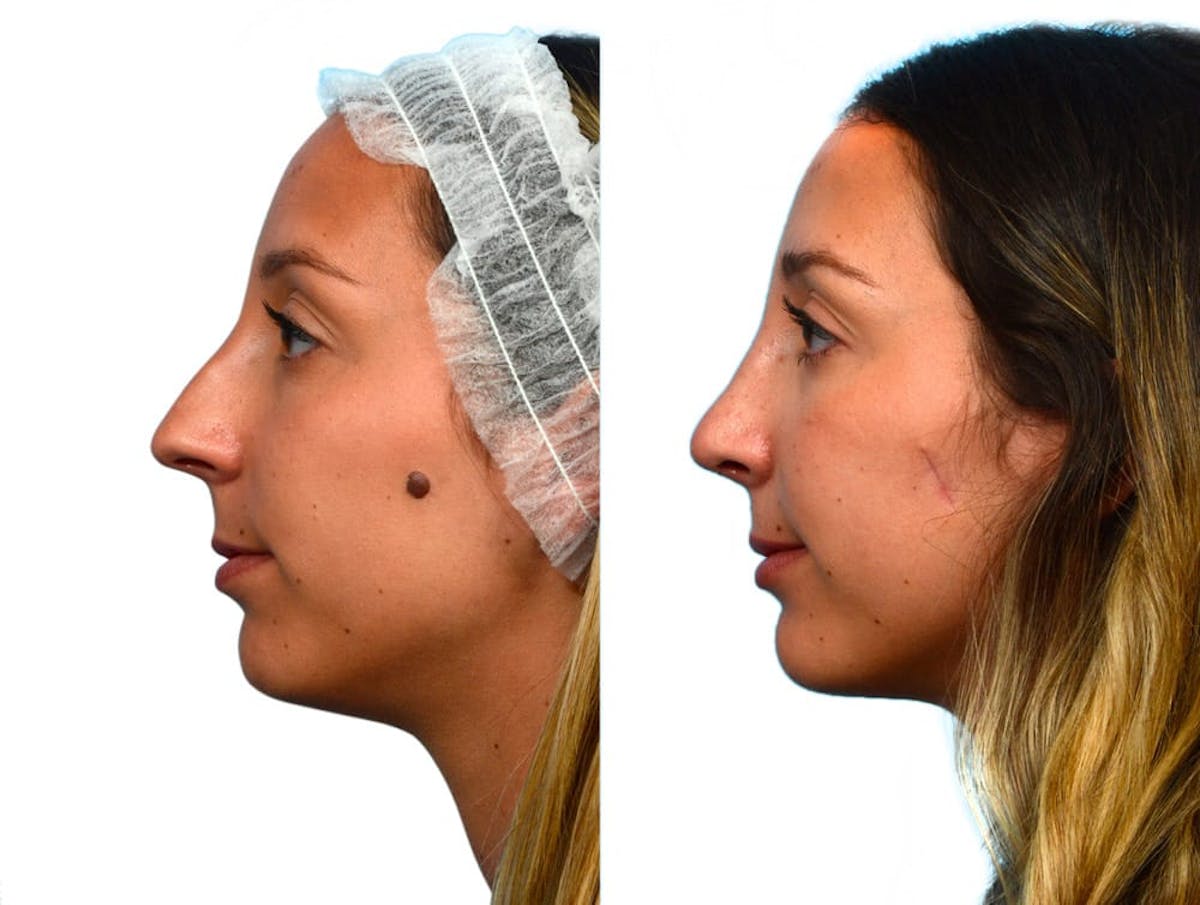 Rhinoplasty Before & After Gallery - Patient 263022 - Image 2