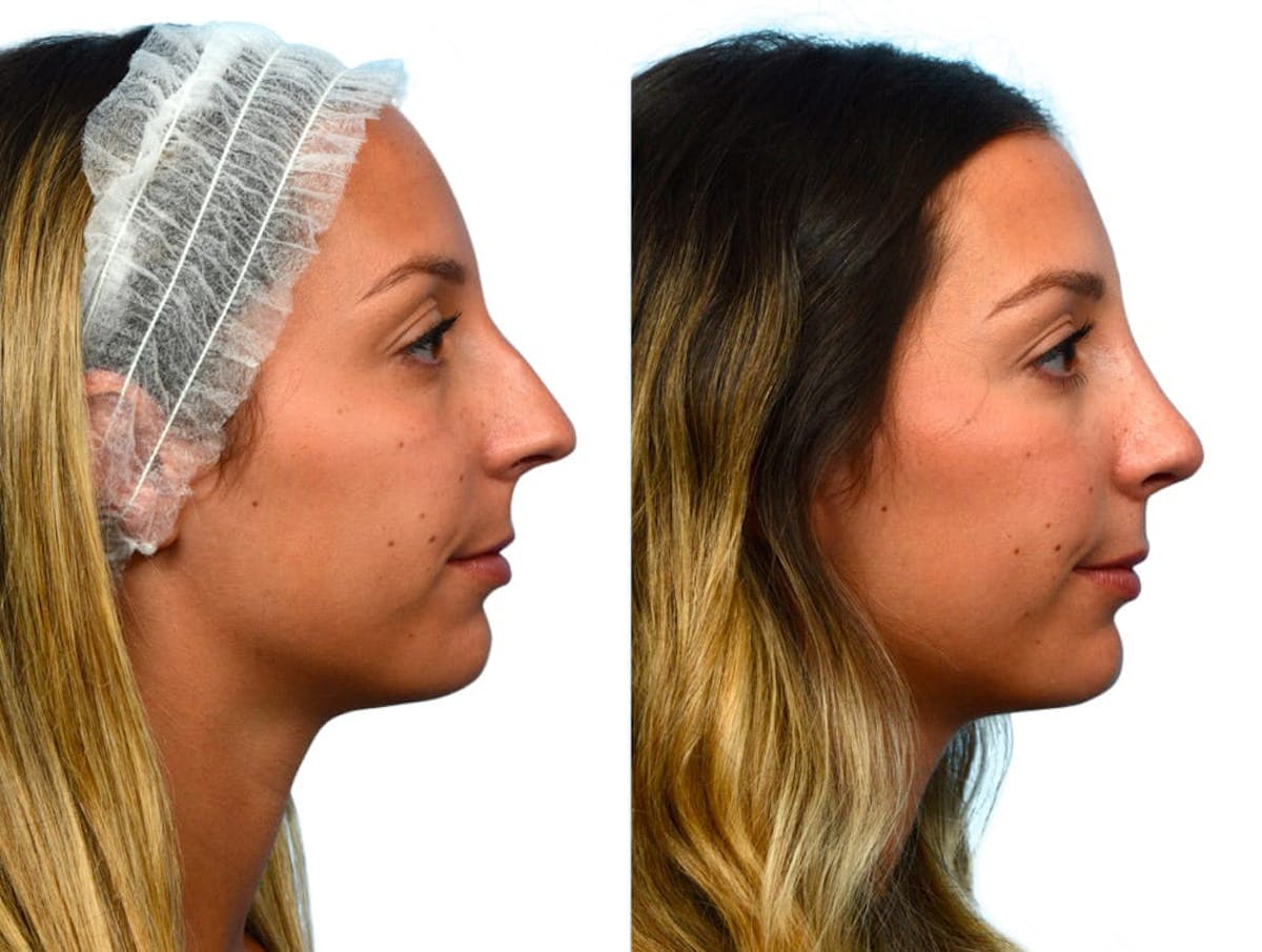 Rhinoplasty Before & After Gallery - Patient 263022 - Image 1