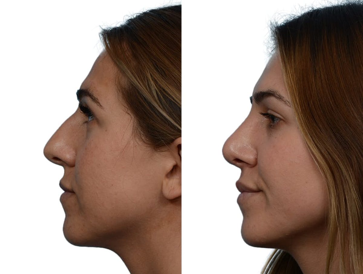 Rhinoplasty Before & After Gallery - Patient 248655 - Image 1