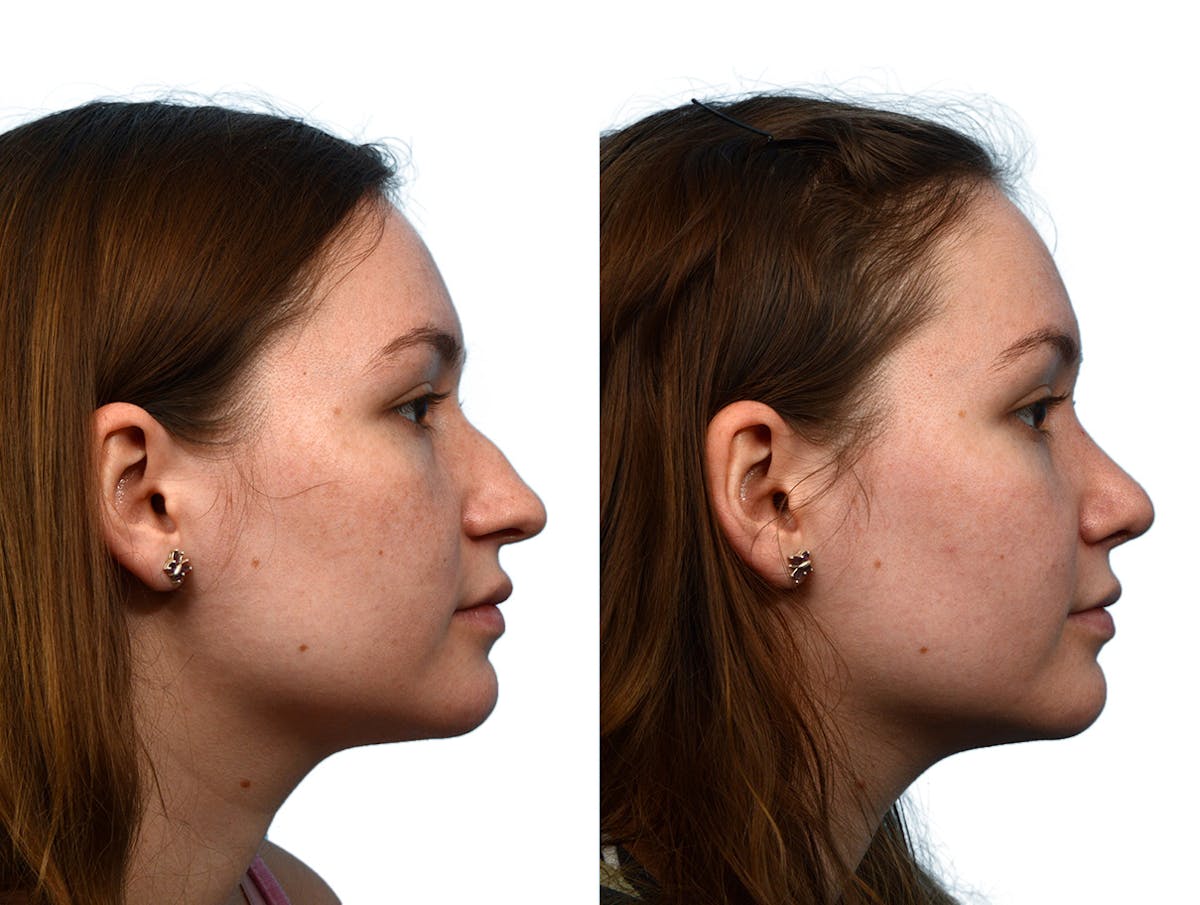 Rhinoplasty Before & After Gallery - Patient 428639 - Image 1