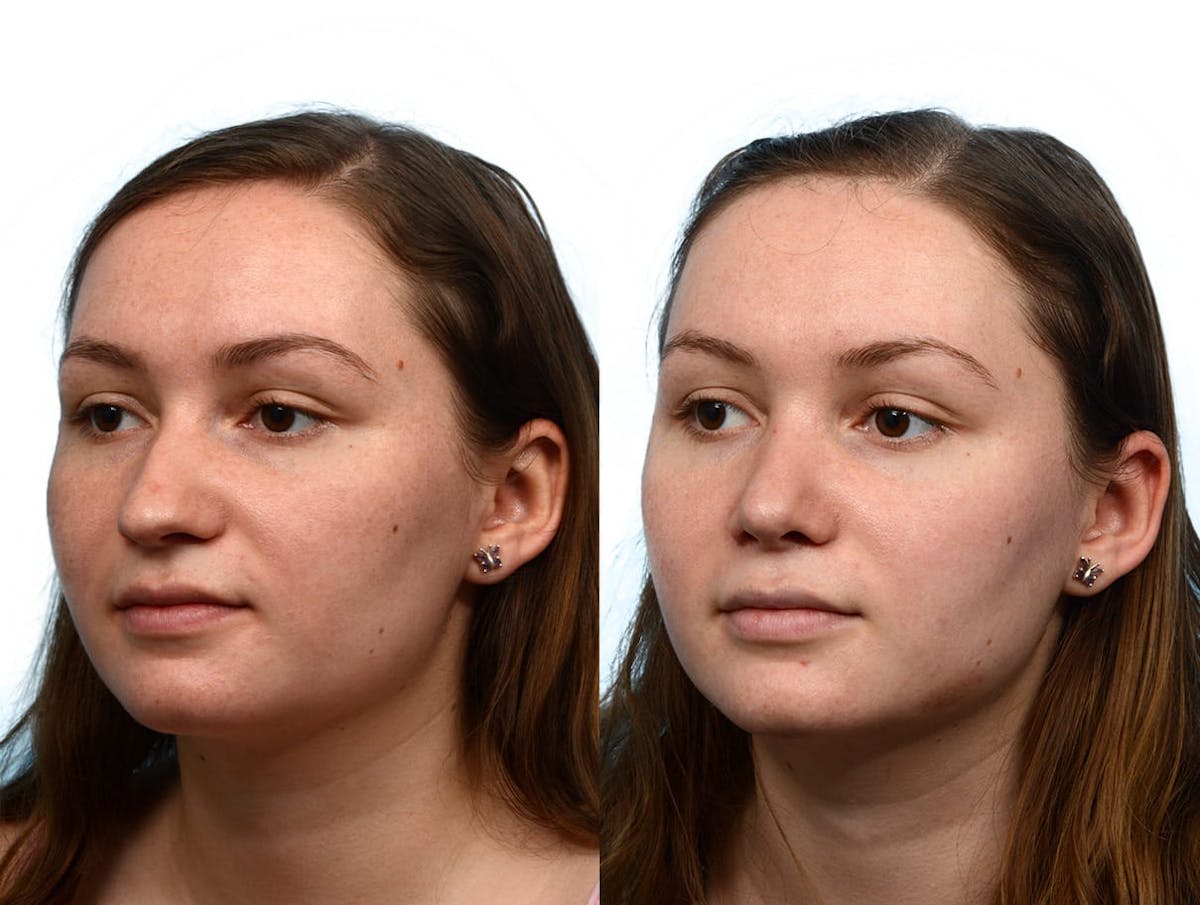 Rhinoplasty Before & After Gallery - Patient 428639 - Image 2