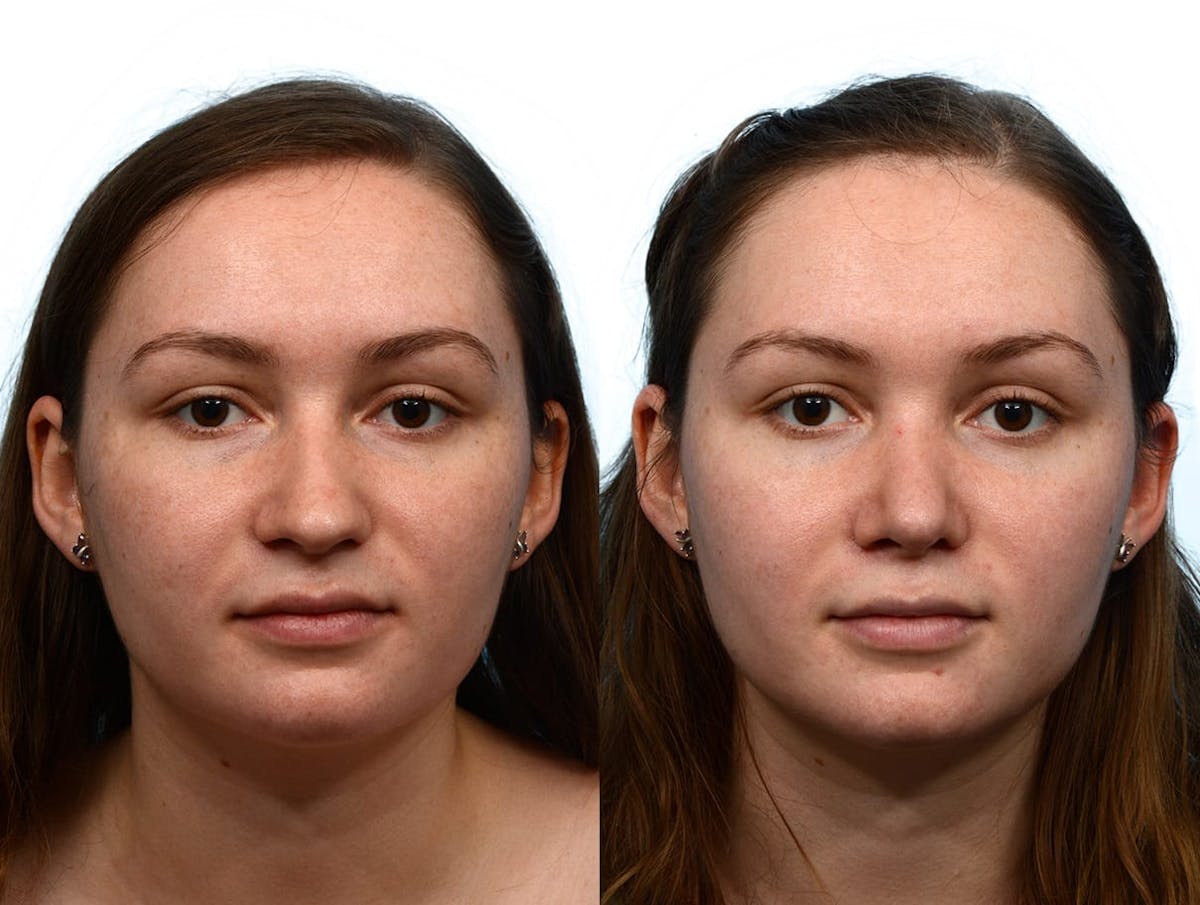 Rhinoplasty Before & After Gallery - Patient 428639 - Image 3