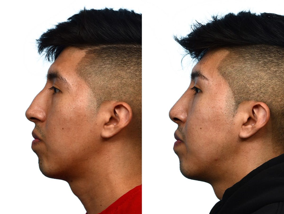 Rhinoplasty Before & After Gallery - Patient 206786 - Image 2
