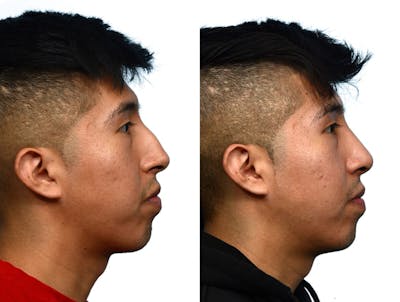 Rhinoplasty Before & After Gallery - Patient 206786 - Image 1