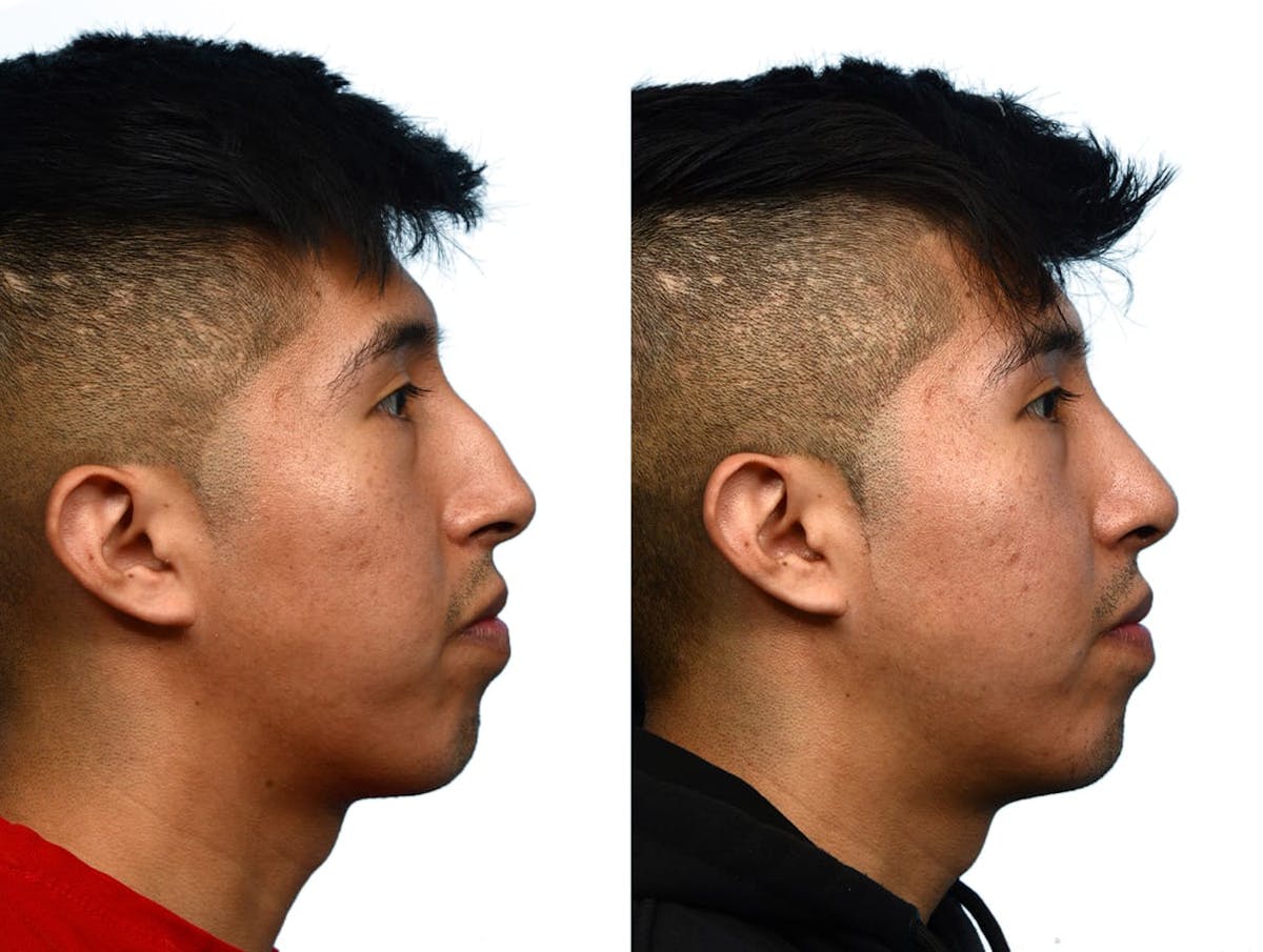 Rhinoplasty Before & After Gallery - Patient 206786 - Image 1