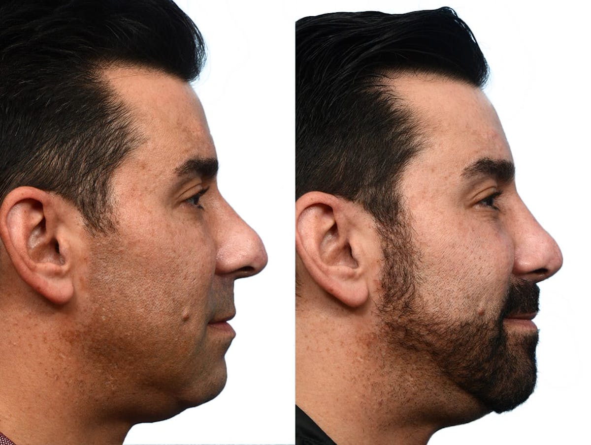 Rhinoplasty Before & After Gallery - Patient 932427 - Image 1