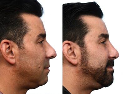 Rhinoplasty Before & After Gallery - Patient 932427 - Image 1