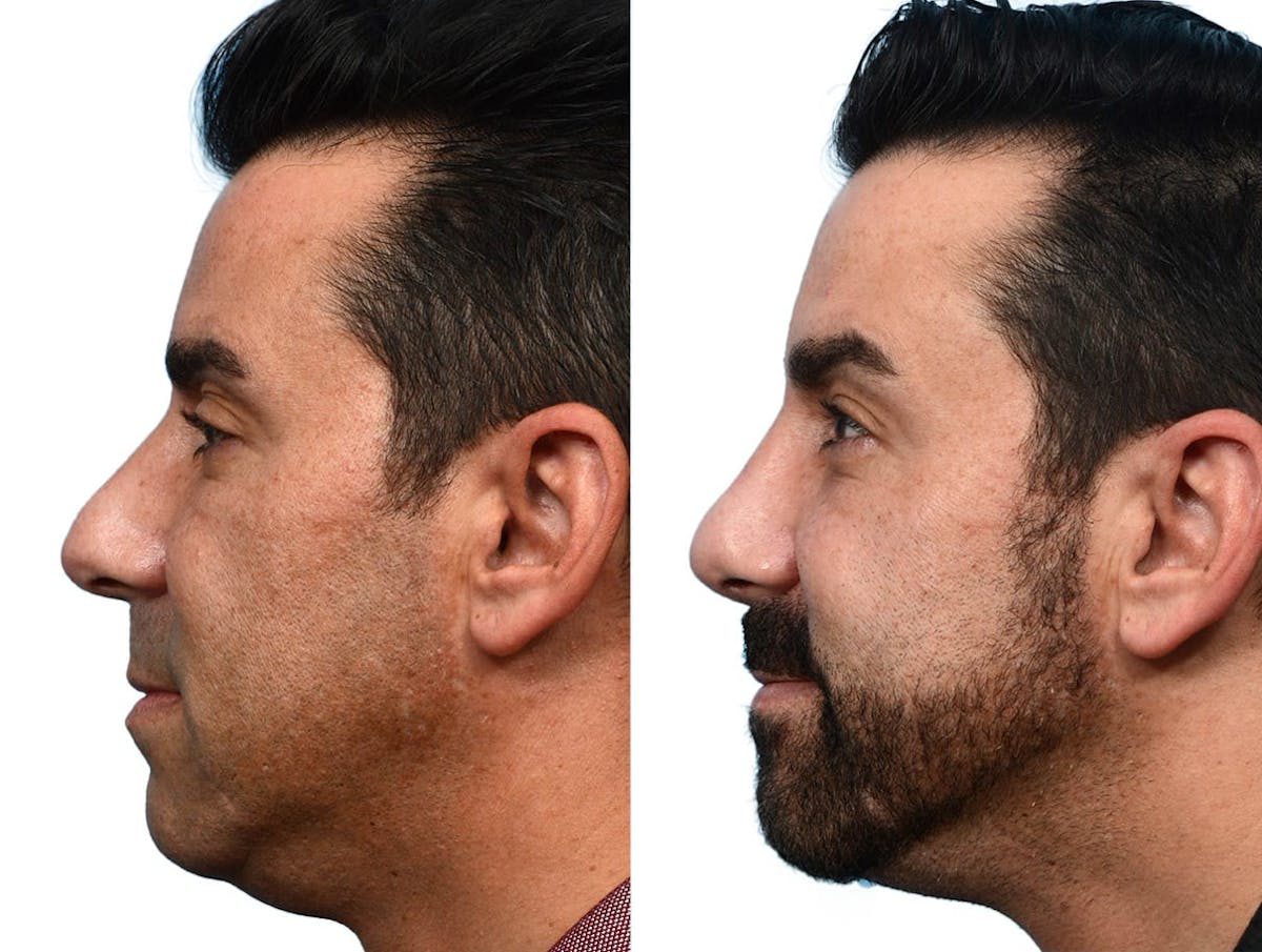 Rhinoplasty Before & After Gallery - Patient 932427 - Image 2
