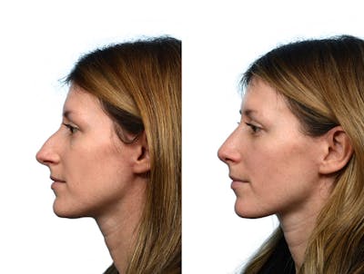 Rhinoplasty Before & After Gallery - Patient 264560 - Image 1