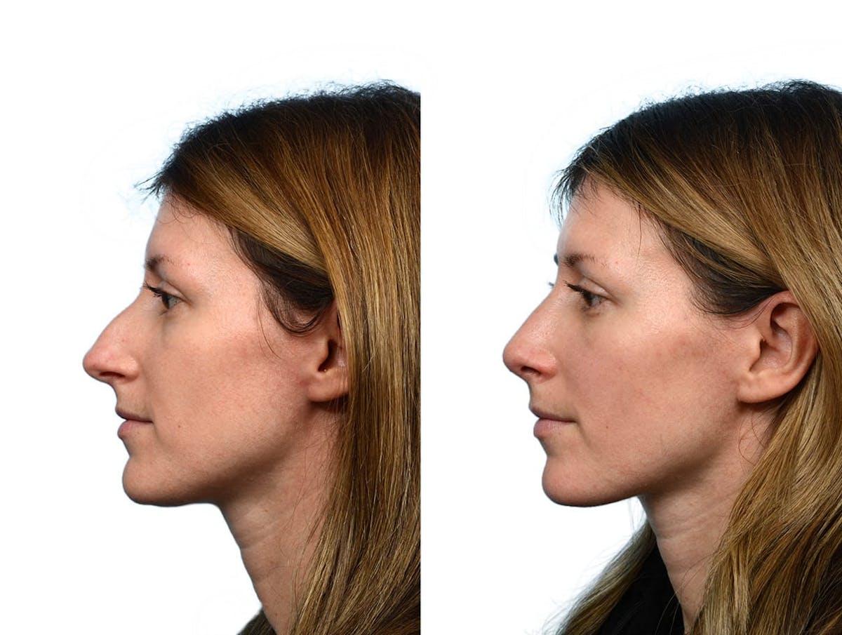 Rhinoplasty Before & After Gallery - Patient 264560 - Image 1