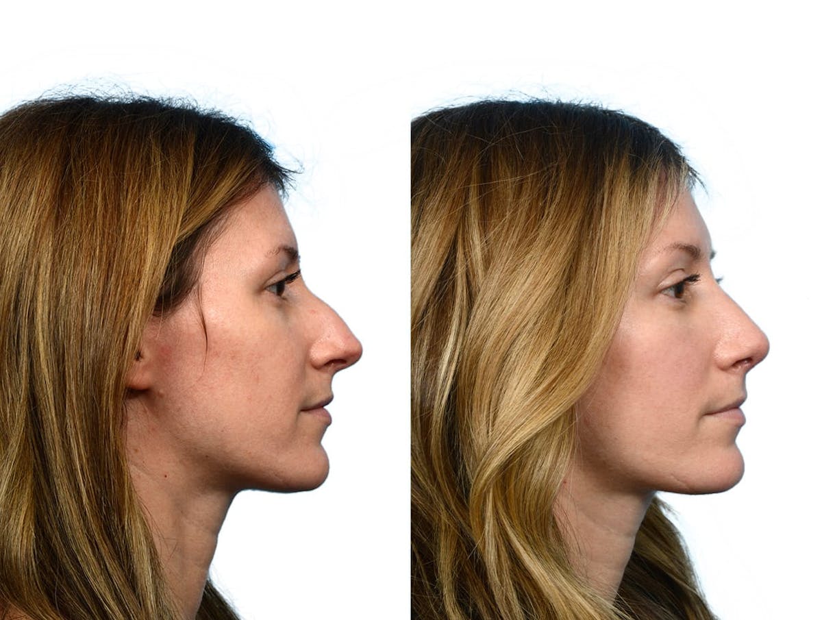 Rhinoplasty Before & After Gallery - Patient 264560 - Image 2