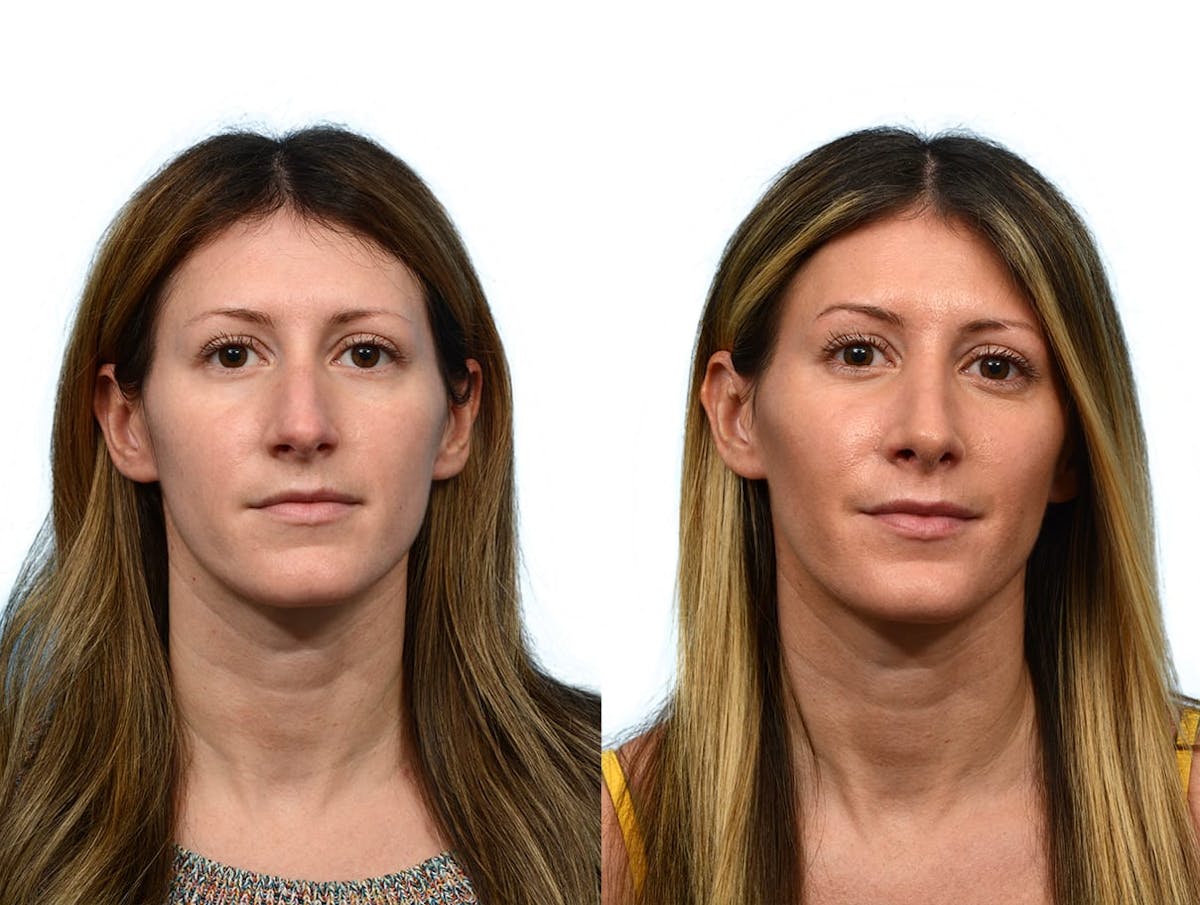 Rhinoplasty Before & After Gallery - Patient 264560 - Image 3