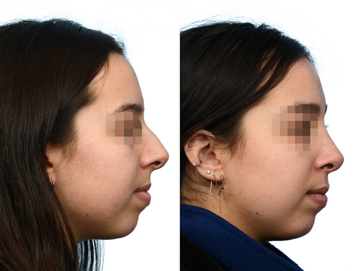 Rhinoplasty Before & After Gallery - Patient 844932 - Image 1